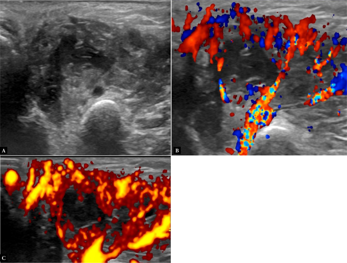 Maxillofacial inflammations visualized with ultrasonography. Description of the imaging features and literature review based on a characteristic case series.