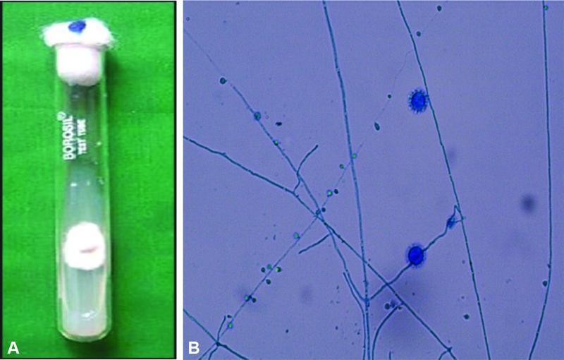 Histoplasmosis of Adrenal Gland: A 5 Years' Review from a Multispecialty Diagnostic Centre.