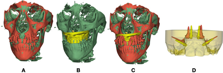 Three-dimensional analysis of miniscrew position changes during bone-borne expansion in young and late adolescent patients.