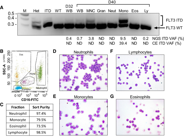 Evaluation of hypereosinophilia in a case of <i>FLT3</i>-mutant acute myeloid leukemia treated with gilteritinib.