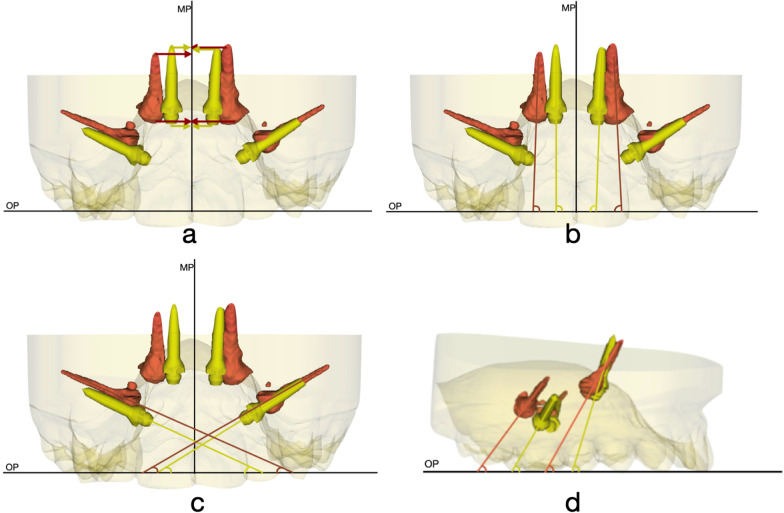 Three-dimensional analysis of miniscrew position changes during bone-borne expansion in young and late adolescent patients.