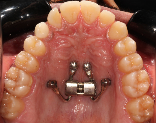 Three-dimensional analysis of miniscrew position changes during bone-borne expansion in young and late adolescent patients.