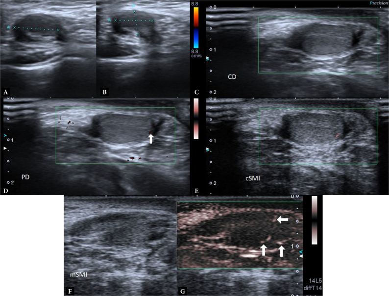 Comparison of conventional Doppler imaging techniques and superb microvascular imaging in determination of vascularization in undescended testes.