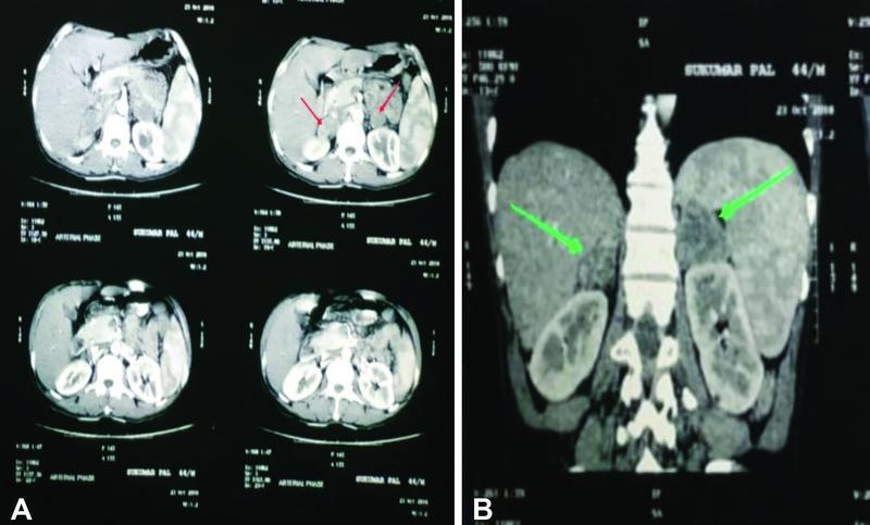 Histoplasmosis of Adrenal Gland: A 5 Years' Review from a Multispecialty Diagnostic Centre.