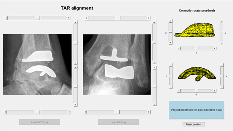 Development and validation of a clinical tool to semi-automatic measure three-dimensional TAR alignment on two-dimensional radiographs.