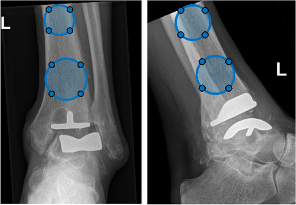 Development and validation of a clinical tool to semi-automatic measure three-dimensional TAR alignment on two-dimensional radiographs.