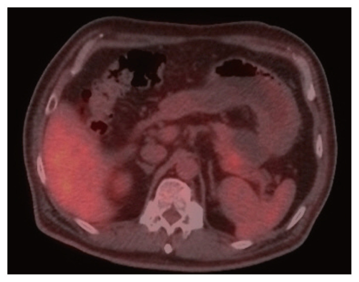 Pancreatic metastasis from papillary thyroid cancer: a case report and literature review.