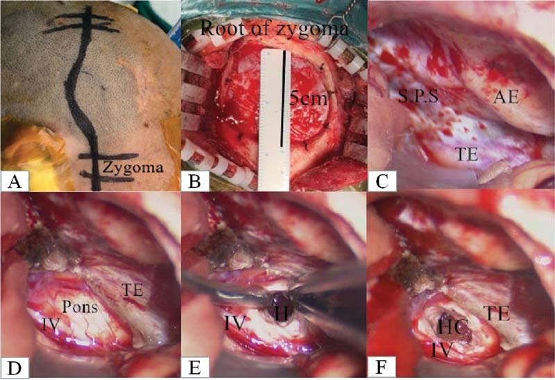 Surgical Treatment for Severe Primary Midbrain and Upper Pons Hemorrhages Using a Subtemporal Tentorial Approach.