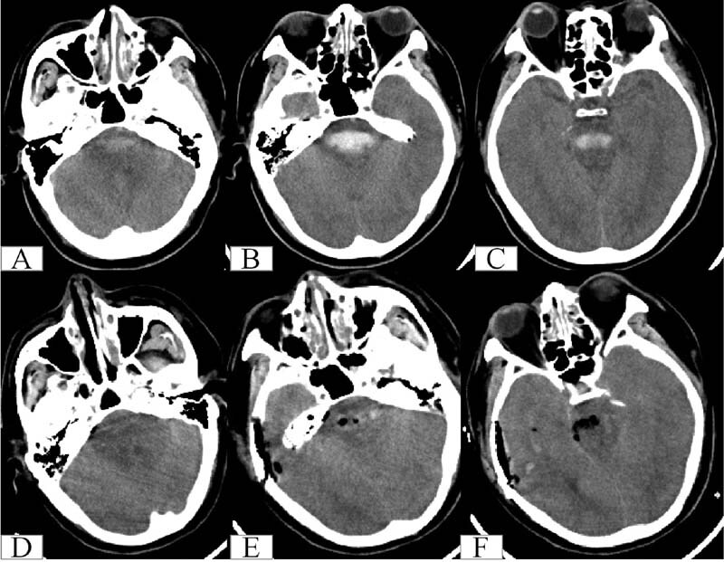 Surgical Treatment for Severe Primary Midbrain and Upper Pons Hemorrhages Using a Subtemporal Tentorial Approach.