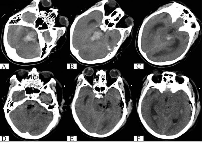 Surgical Treatment for Severe Primary Midbrain and Upper Pons Hemorrhages Using a Subtemporal Tentorial Approach.