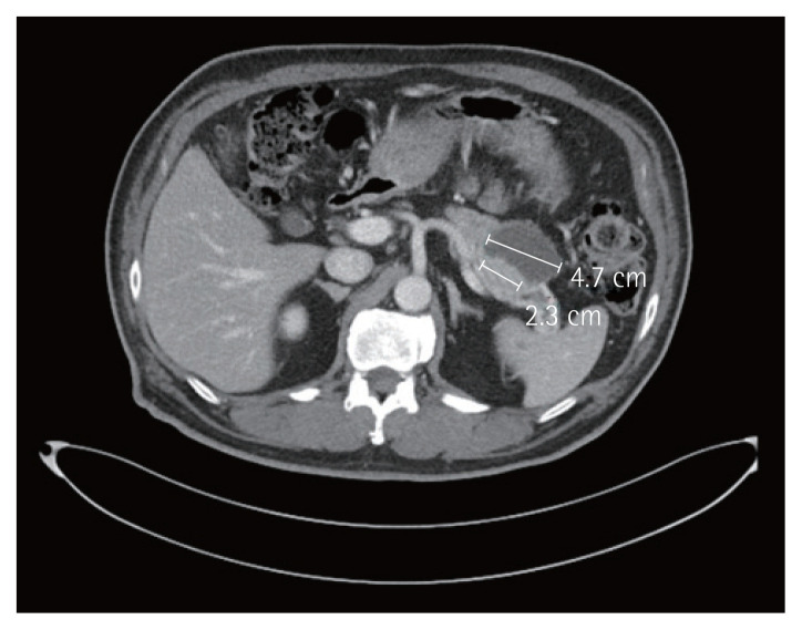 Pancreatic metastasis from papillary thyroid cancer: a case report and literature review.