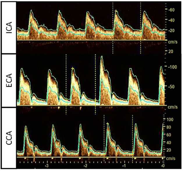 Doppler flow morphology characteristics of epiaortic arteries in aortic valve pathologies: a retrospective study on a cohort of patients with ischemic stroke.