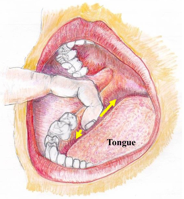 Application of Tinel's test combed with clinical neurosensory test distinguishes spontaneous healing of lingual nerve neuropathy after mandibular third molar extraction.