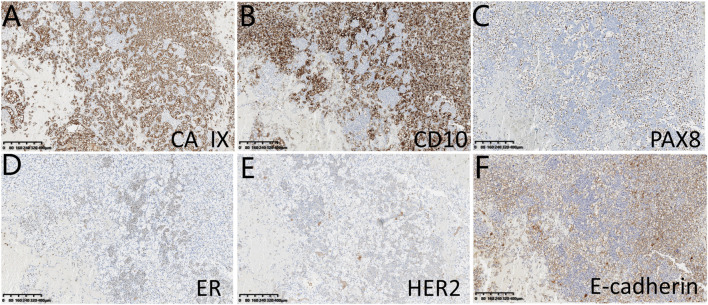 Case report: A rare case of tumor-to-tumor metastasis: metastatic lobular breast carcinoma to clear cell renal cell carcinoma.