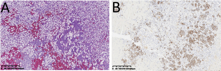 Case report: A rare case of tumor-to-tumor metastasis: metastatic lobular breast carcinoma to clear cell renal cell carcinoma.