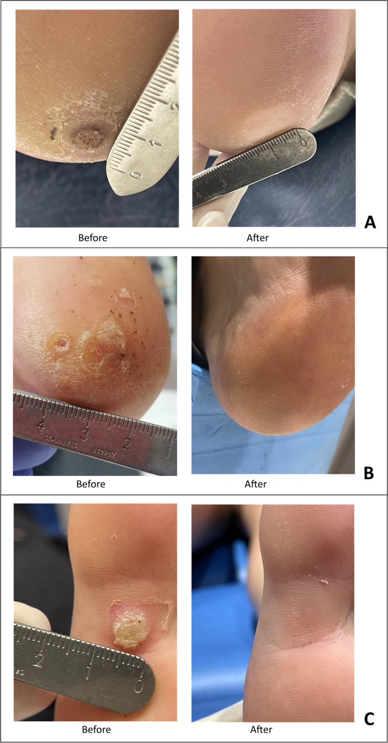 Microwave therapy for the treatment of plantar warts.