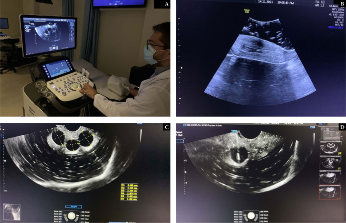 Self-made transvaginal ultrasound simulator: new training equipment in ultrasound evaluation of controlled ovarian stimulation and oocyte retrieval.