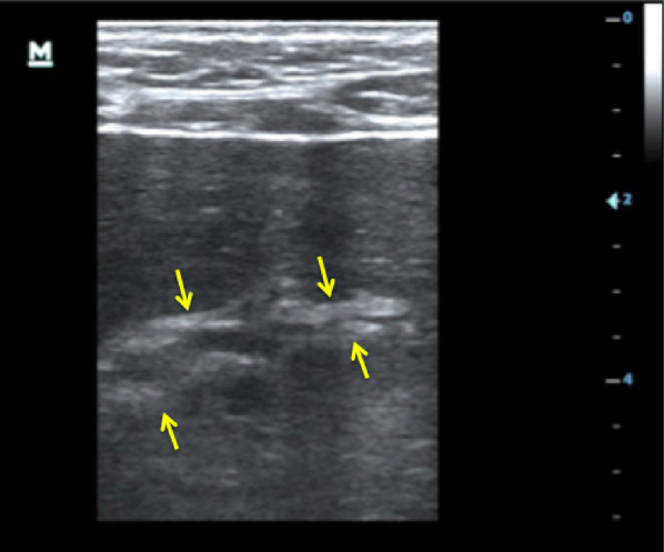 Ultrasound findings in Kaposi sarcoma patients: overlapping sonographic features with disseminated tuberculosis.