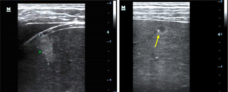 Ultrasound findings in Kaposi sarcoma patients: overlapping sonographic features with disseminated tuberculosis.