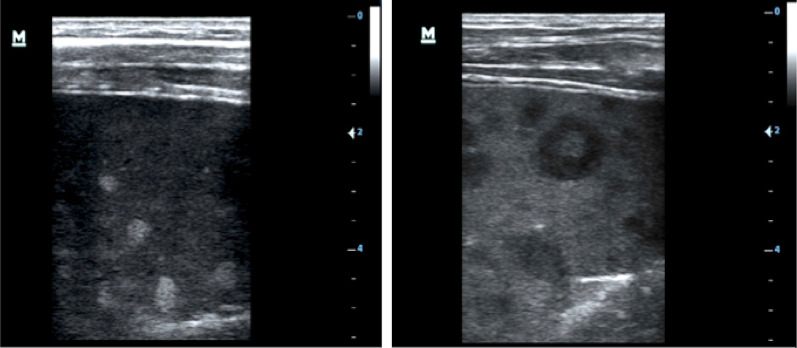 Ultrasound findings in Kaposi sarcoma patients: overlapping sonographic features with disseminated tuberculosis.