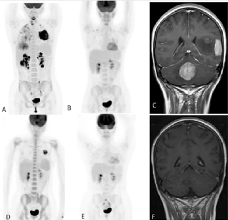 Thinking Outside the Box in Mediastinal Lymphoma Management.