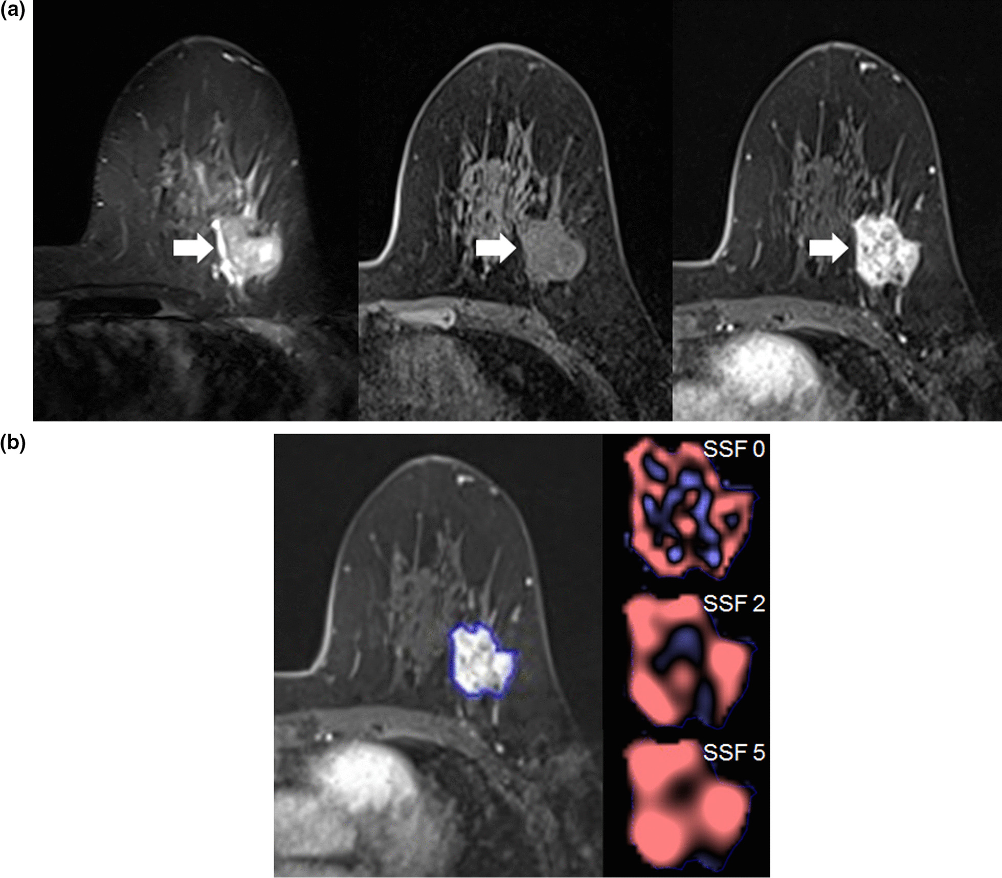 MRI-based breast cancer radiogenomics using RNA profiling: association with subtypes in a single-center prospective study.