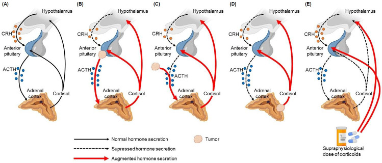 Cushing disease in pediatrics: an update.