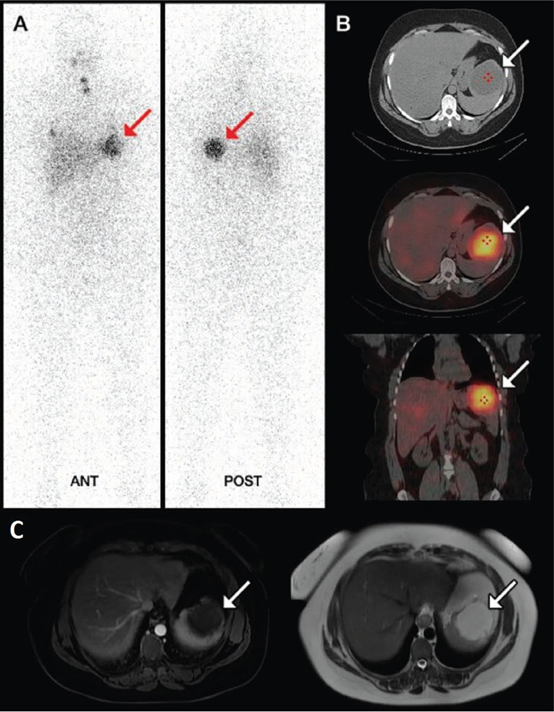 Incidental Spleen Cyst Mimicking Thyroid Carcinoma Metastasis: False-positive Uptake on Radioiodine Whole Body Scan.