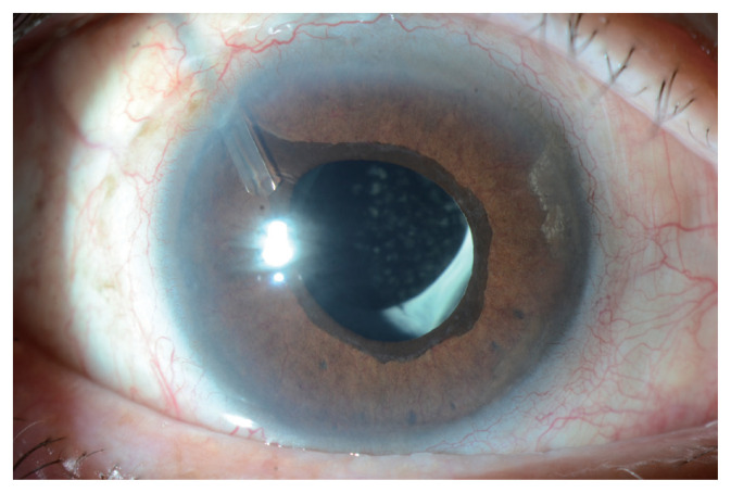 Neovascular Glaucoma Associated with Chronic Rhegmatogenous Retinal Detachment.