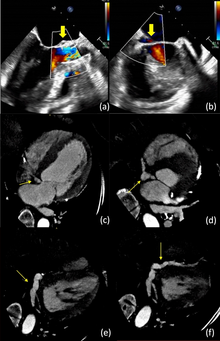 An "arboreal" infective pseudoaneurysm following TAVR with "pseudovascular" distribution and morphology.