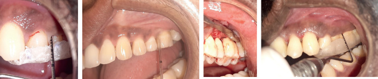 Assessment of Wound Healing Using MMP-8 Levels in GCF of Diabetics With Chronic Periodontitis After Diode Laser Assisted Flap Surgery.