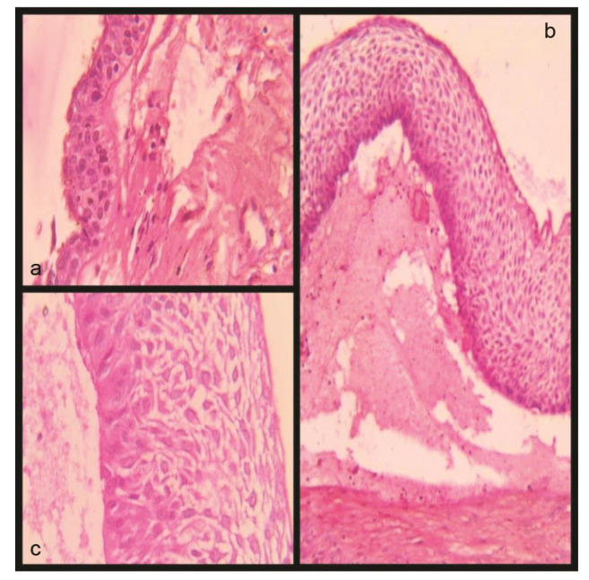 Conservative Management of Unicystic Ameloblastoma of Mandible Evolving from Dentigerous Cyst in a Paediatric Patient: A Case Report.