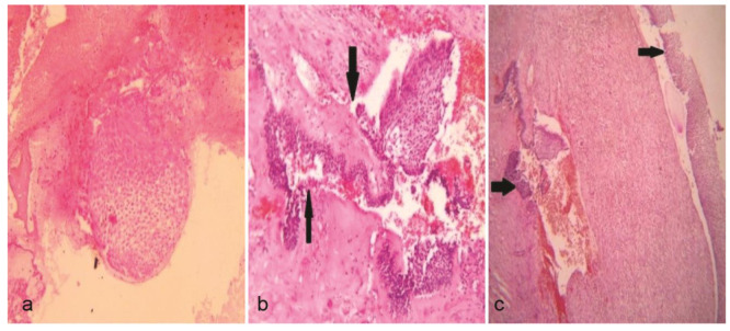 Conservative Management of Unicystic Ameloblastoma of Mandible Evolving from Dentigerous Cyst in a Paediatric Patient: A Case Report.