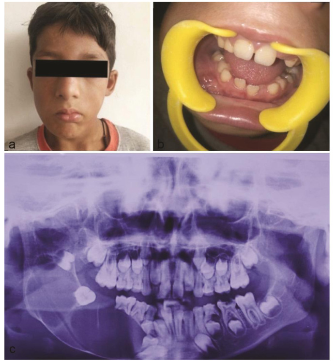 Conservative Management of Unicystic Ameloblastoma of Mandible Evolving from Dentigerous Cyst in a Paediatric Patient: A Case Report.