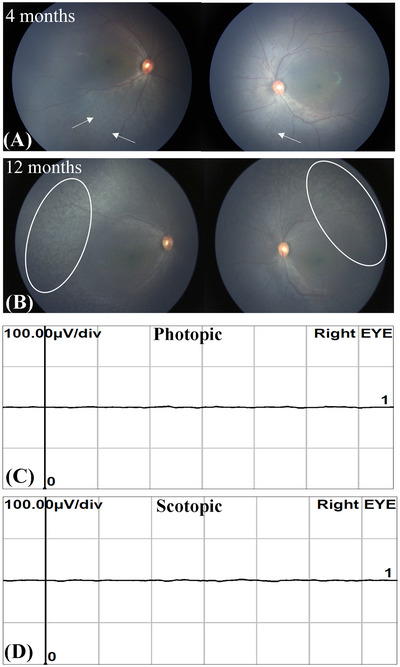 A novel pathogenic variant of <i>CEP164</i> in an infant with Senior-Loken syndrome.