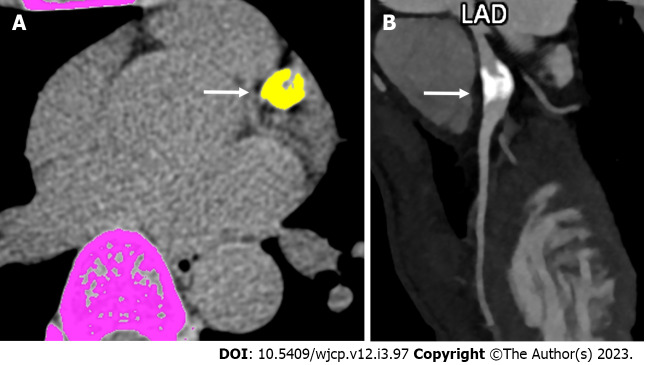 Emerging role of computed tomography coronary angiography in evaluation of children with Kawasaki disease.