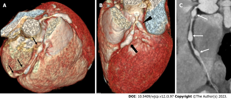 Emerging role of computed tomography coronary angiography in evaluation of children with Kawasaki disease.