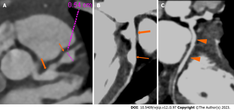 Emerging role of computed tomography coronary angiography in evaluation of children with Kawasaki disease.