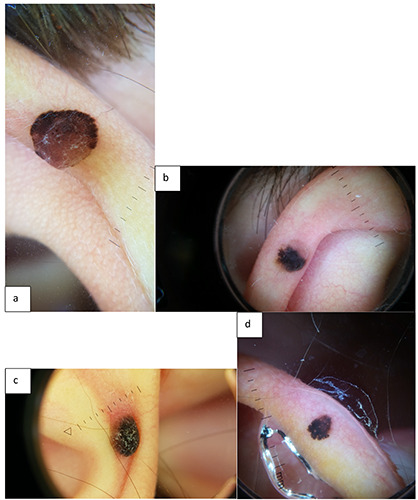 Pediatric spitzoid lesions of the ear: a single-center experience and review of the literature.