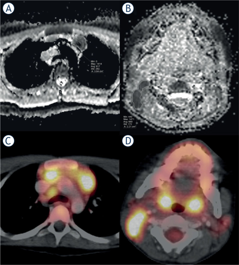 Correlation of mean apparent diffusion coefficient (ADC) and maximal standard uptake value (SUVmax) evaluated by diffusion-weighted MRI and 18F-FDG-PET/CT in children with Hodgkin lymphoma: a feasibility study.