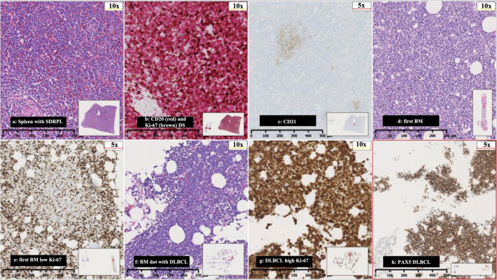 An Aggressive Course of Transformed Splenic Diffuse Red Pulp Small B-Cell Lymphoma With Novel Somatic Loss-of-Function Mutation in <i>RB1</i>.