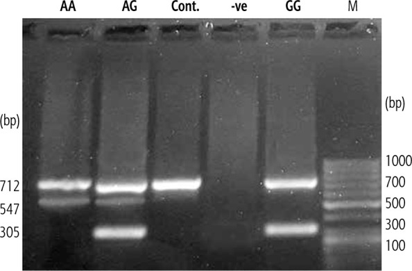 Bone morphogenic protein-7 (BMP-7) polymorphism: Susceptibility to cirrhosis and hepatocellular carcinoma after viral hepatitis in Egyptian patients.