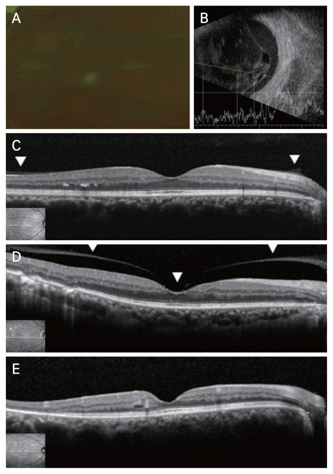 Tractional Retinal Detachment in Eyes with Vitreous Hemorrhage and Proliferative Diabetic Retinopathy and Posterior Vitreous Detachment in Fellow Eye.