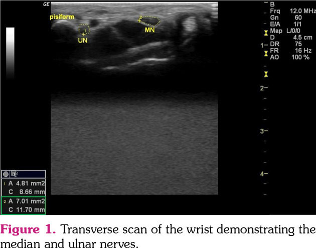 Comparison of the median and ulnar nerves of rheumatoid arthritis patients and healthy subjects by ultrasound.