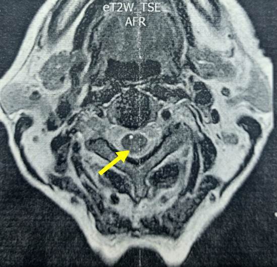 Myelopathy due to copper deficiency: A case series and review of the literature