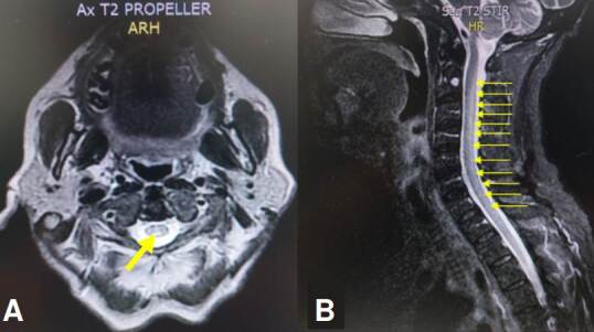 Myelopathy due to copper deficiency: A case series and review of the literature