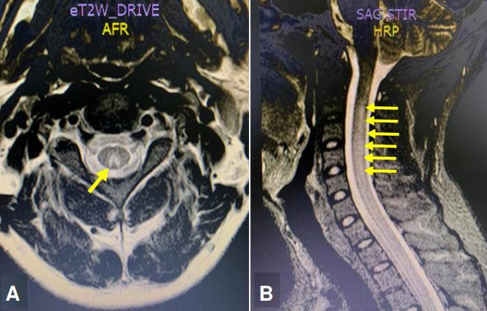 Myelopathy due to copper deficiency: A case series and review of the literature