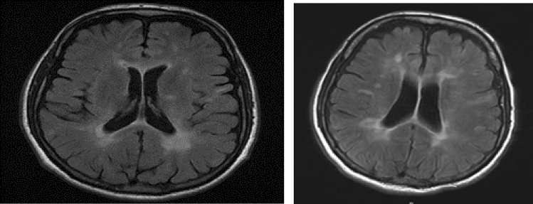 Co-occurrence of Multiple Sclerosis and Severe Aplastic Anemia: A Report of Two Cases Successfully Treated with Allogeneic Hematopoietic Stem Cell Transplantation.