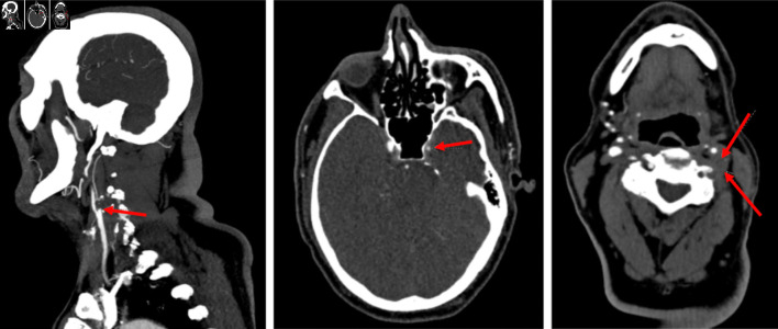 Identifying the Cause of Acute Left-Sided Visual Loss: A Clinical Dilemma.