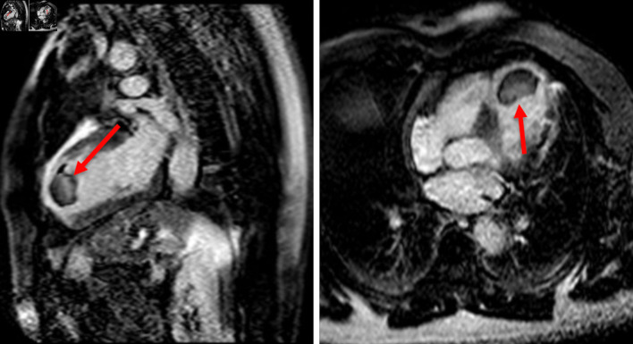 Identifying the Cause of Acute Left-Sided Visual Loss: A Clinical Dilemma.